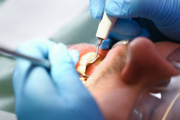 Best Emergency Tooth Extraction in Clay, CA