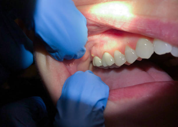 Best Emergency Denture Repair in Clay, CA