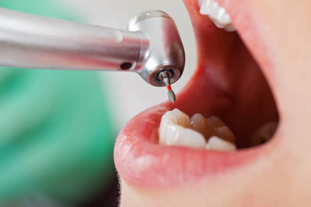 Best Emergency Tooth Extraction in Clay, CA